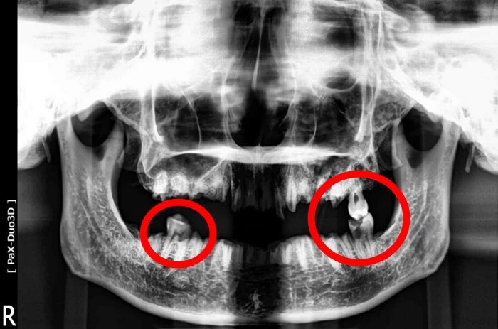 이하 인천 계양경찰서 제공 / 훼손된 시신에 남은 치아 3개