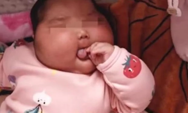 호르몬 함유된 유아용 크림 발라 얼굴이 부풀어 오른 중국 생후 5개월된 유아