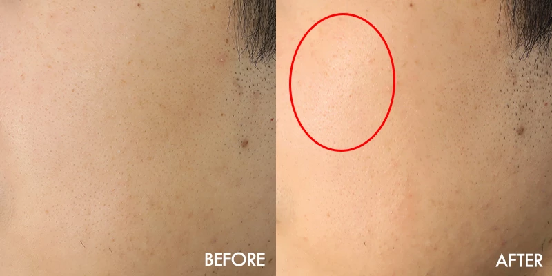 광이 돌고 모공이 축소 됨.