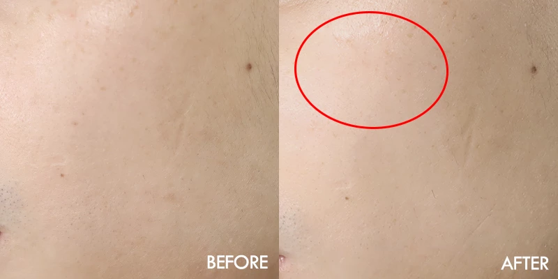 잡티가 옅어지고 피부결이 개선됨.