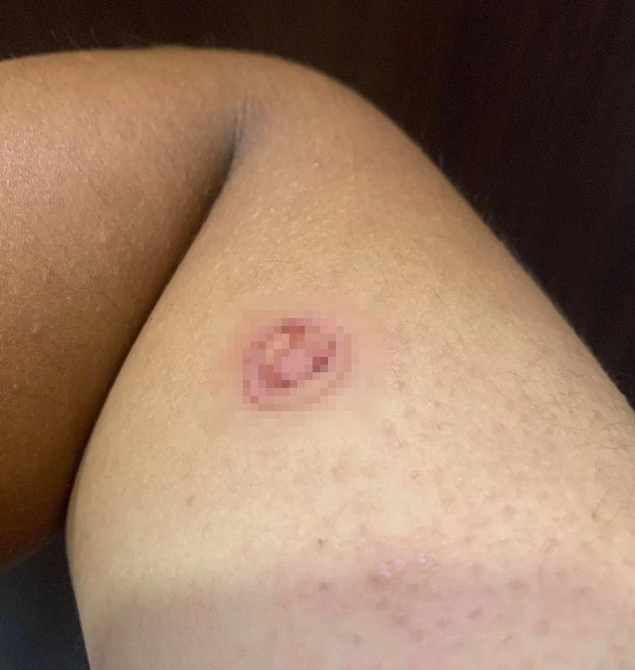 팔에 남은 상처 / 페이스북 '육군훈련소 대신 전해드립니다'