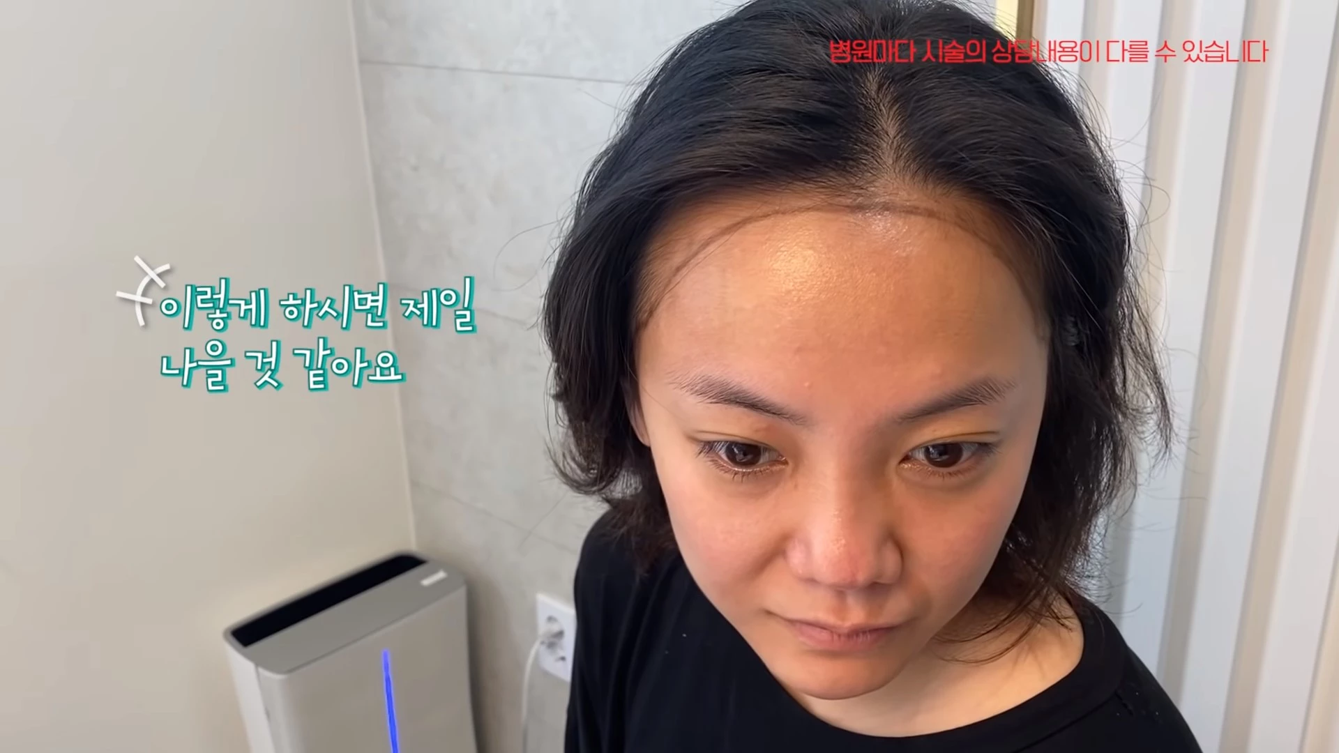 모발이식 받기 전