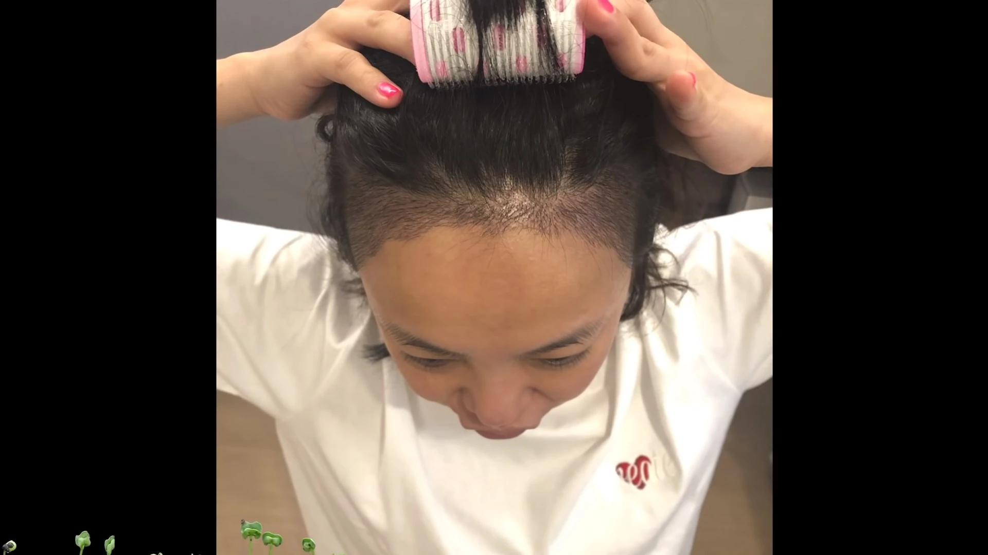 모발이식 받은 후