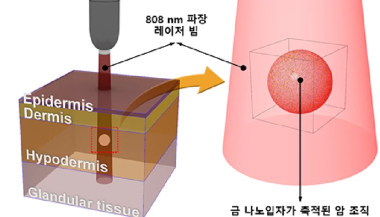 다중 층으로 구성된 유방조직에서의 금나노입자를 이용한 광열 유방암 치료 모식도   / 한국기초과학지원연구원