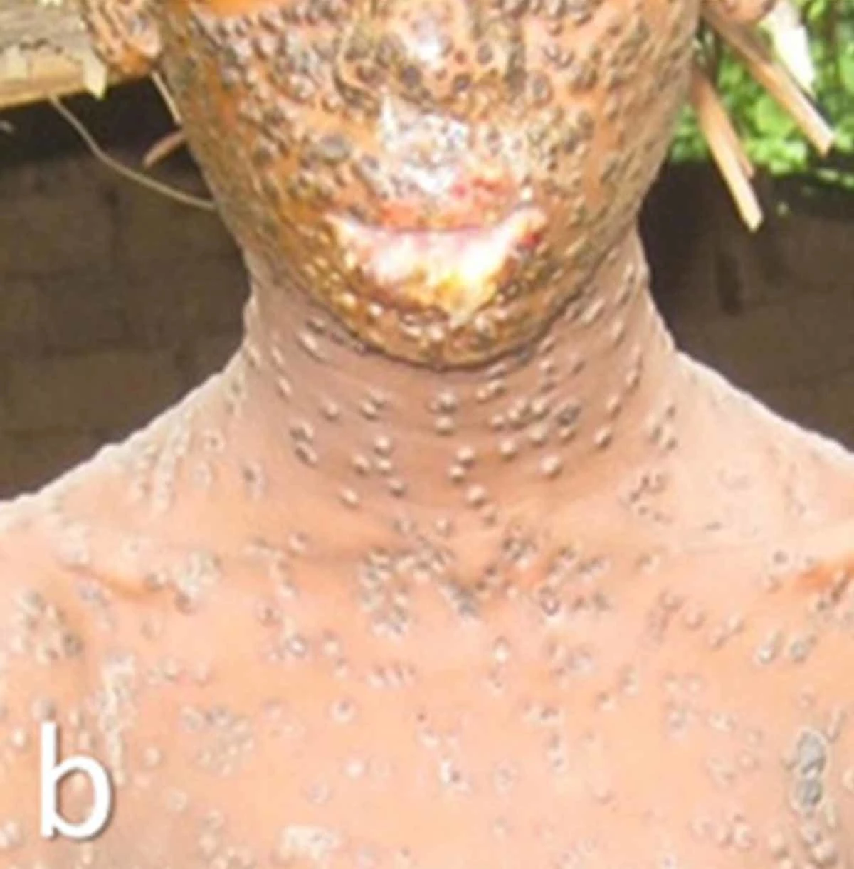 원숭이두창 환자 / 미국 열대의학 및 위생학회(ASTMH)