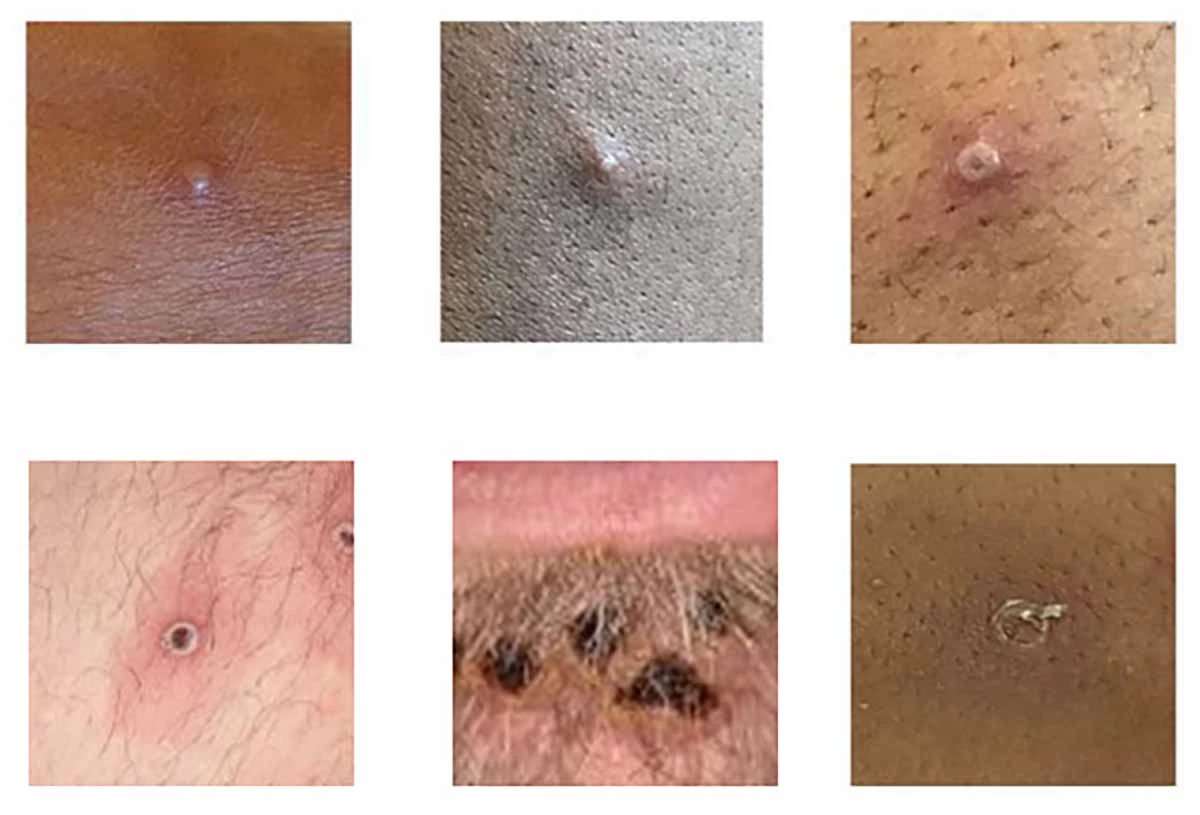 원숭이두창 환자의 피부병변 / 사진=미국 질병통제예방센터(CDC)