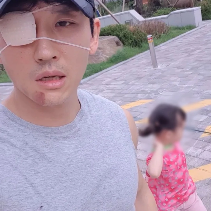 구안와사로 입원 치료 후 퇴원한 박지헌. 지난 6일 공개한 마비가 온 얼굴 상태
