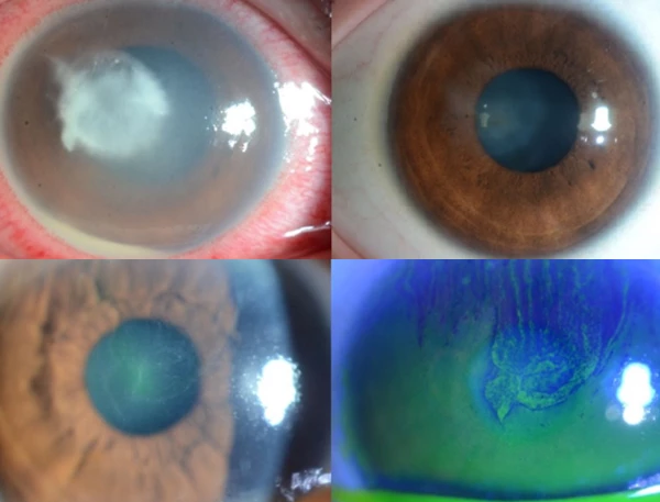 한국콘텍트렌즈협회