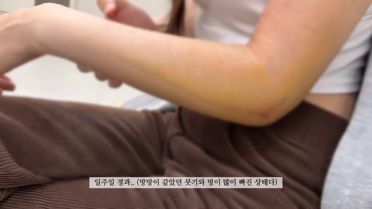 부상 일주일 후 경리 팔 상태