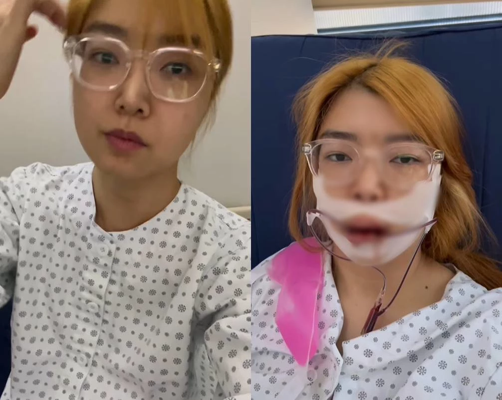 양악수술 들어가기 직전, 직후 사진 비교 / 이하 '나는 솔로' 10기 영자 인스타그램