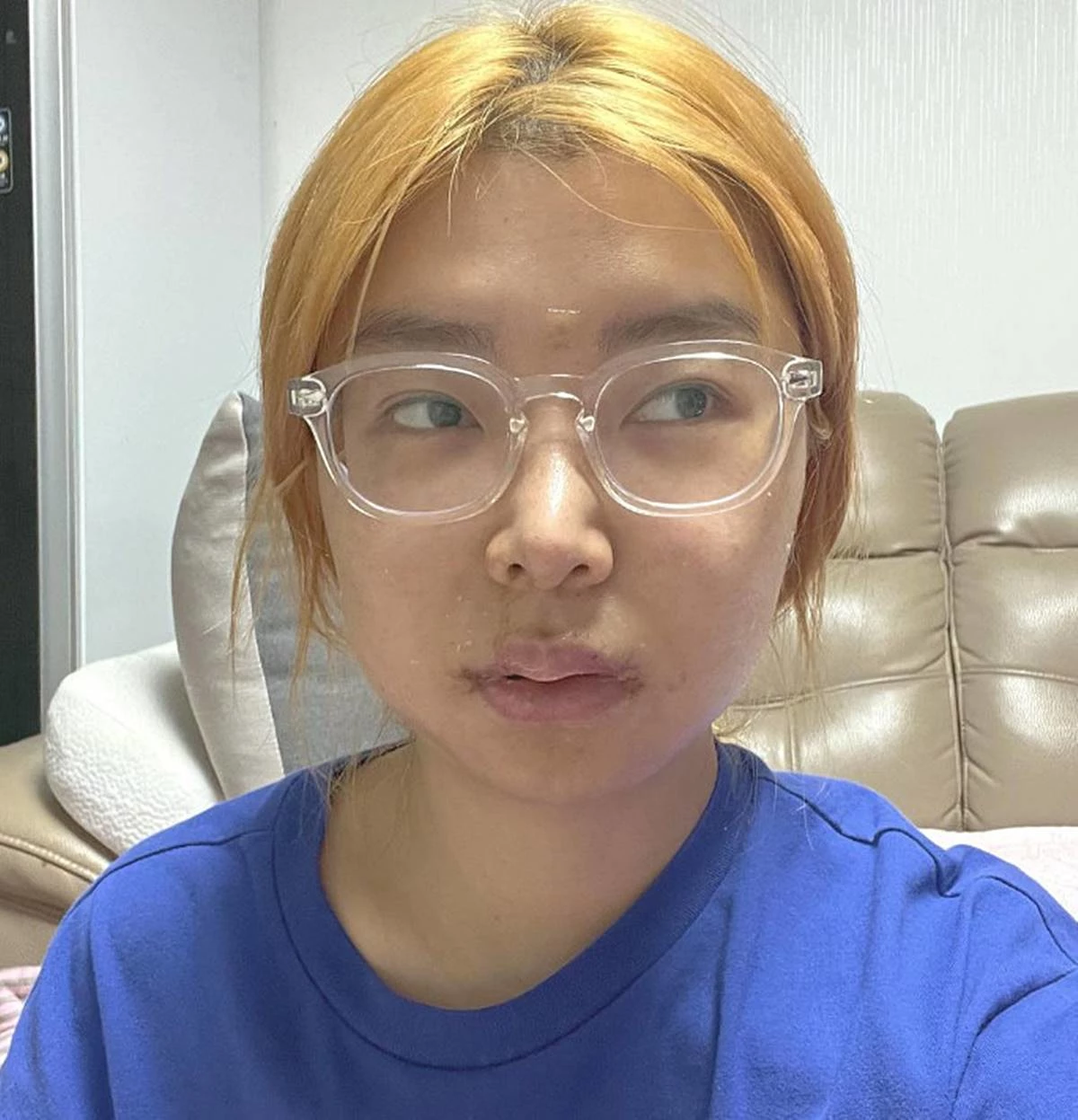 양악수술 5일 차 사진