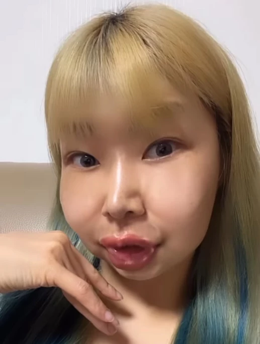 양악 수술 후 얼굴 필터를 적용한 개그 영상을 올렸다가 정신 이상설에 휘말린 영자