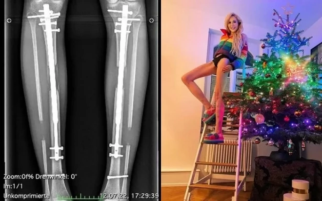 사지 연장술 수술 후기를 남긴 테레지아 피셔