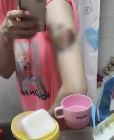 가해자의 폭행으로 팔에 멍이든 모습.