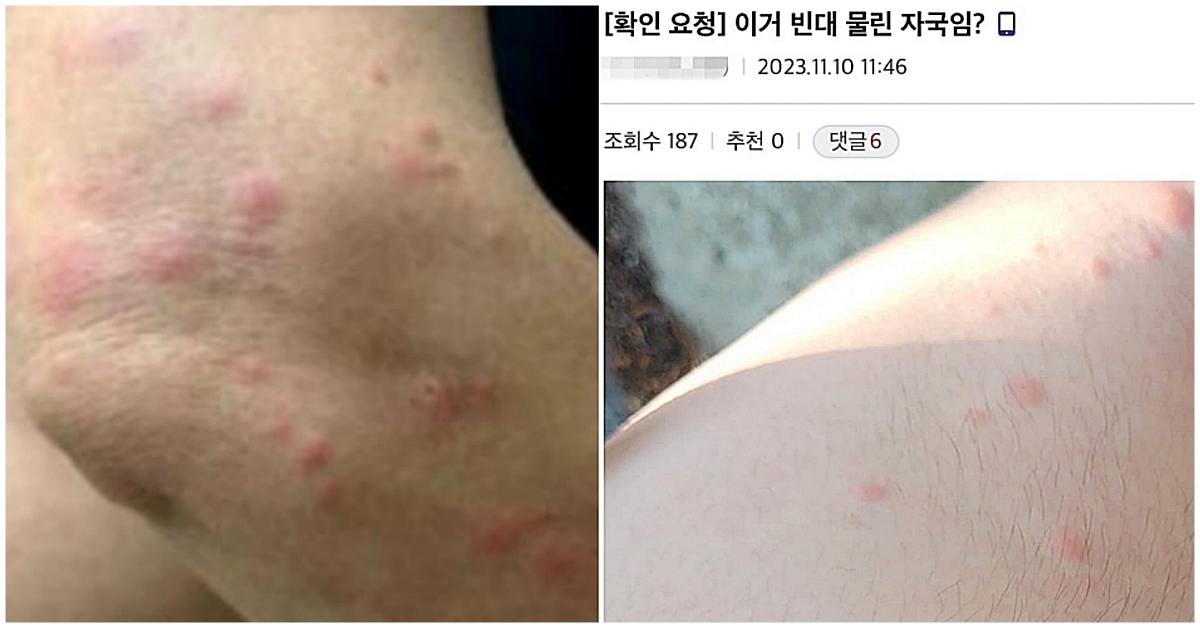 “모기 물린 건가? 혹시 빈대?”… 헷갈린다면 무조건 확인하세요 (+사진 비교) | 위키트리