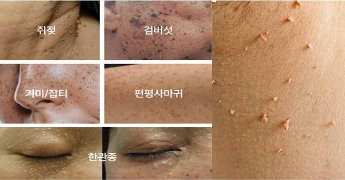 점점 늘어나는 쥐젖, 비립종... 재발 예방하는 관리법 | 위키트리