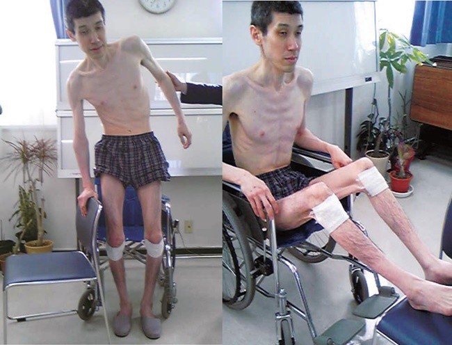 12년 5개월 동안 납치감금 된 직후의 고토 토오루 대표 (2008년 당시, 182cm, 약 45kg)