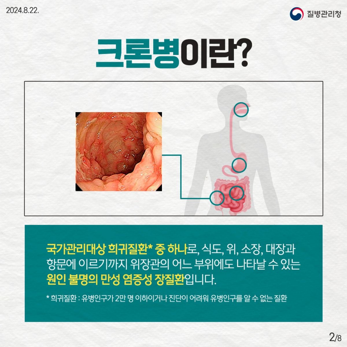 크론병이란? / 질병관리정 제공