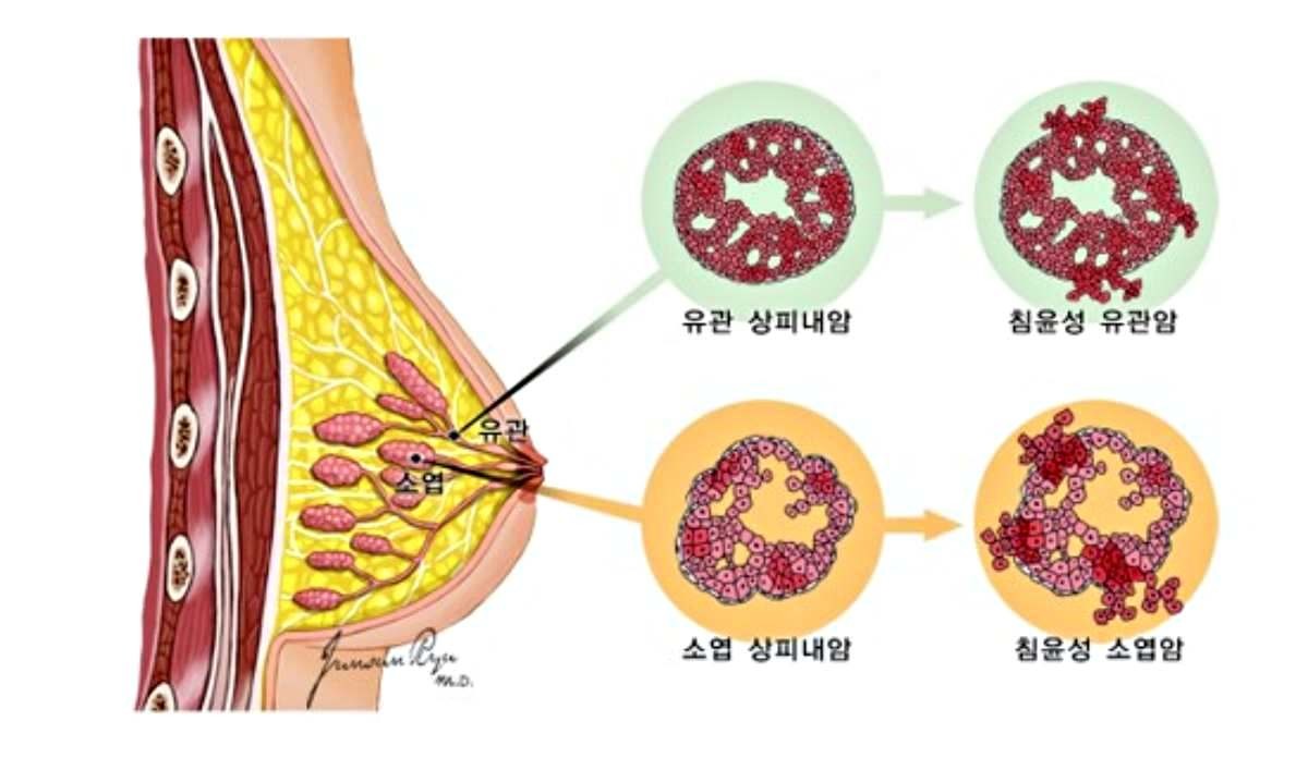 유방암 종류. / 국립암정보센터