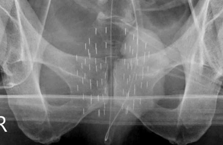 브라키 테라피 시술직후 투시 X-ray 사진. 가지런히 배열된 방사선 동위원소를 확인할 수 있다.