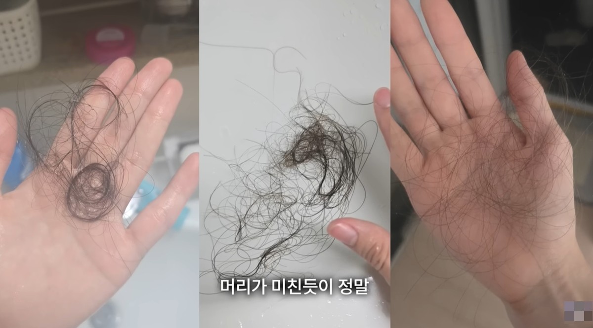 약 부작용으로 심하게 빠지는 머리카락. / 유튜브 채널