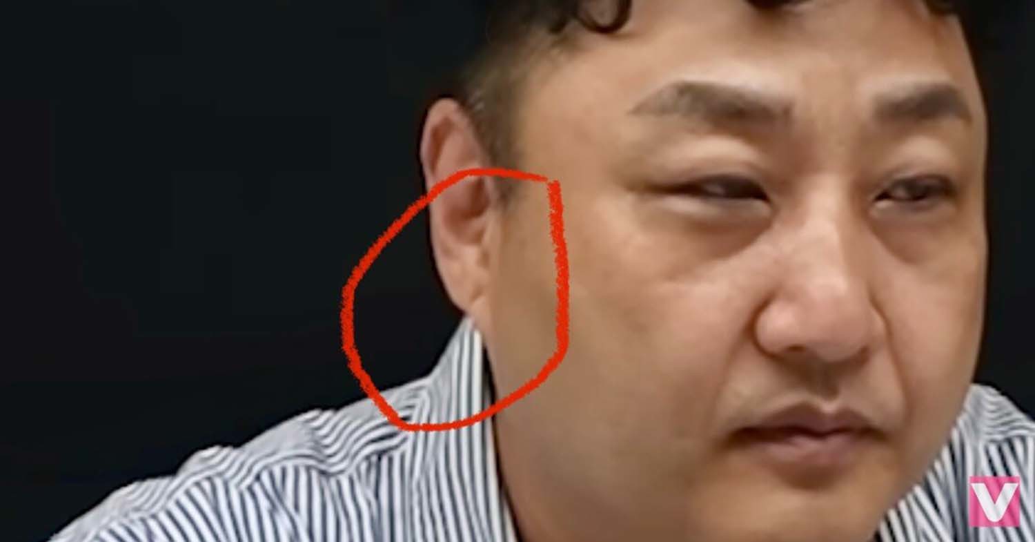 한 네티즌이 에펨코리아에 올린 김수용 사진. 그는 김수용의 귓볼에 프랭크 징후가 있었다고 주장했다. / 에펨코리아