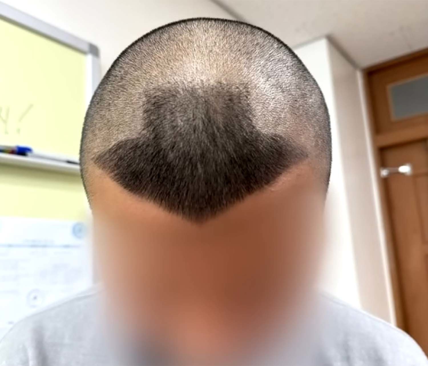 피해 학생의 머리. /  JTBC '사건반장'