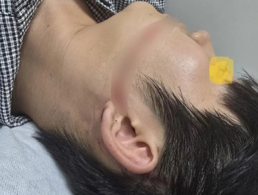 지난해 경기 안산에서 발생한 ‘고압 워터건 사고’로 A씨가 얼굴에 찰과상을 입은 모습 / 연합뉴스