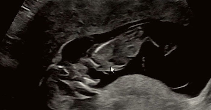 임신 12주차였을 때 초음파 사진 / 유튜브 '변비부부'