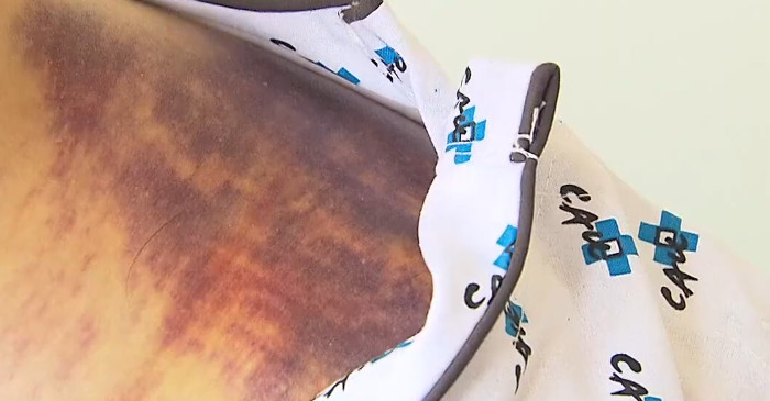 부상당한 상처 / 유튜브 'KBS News'