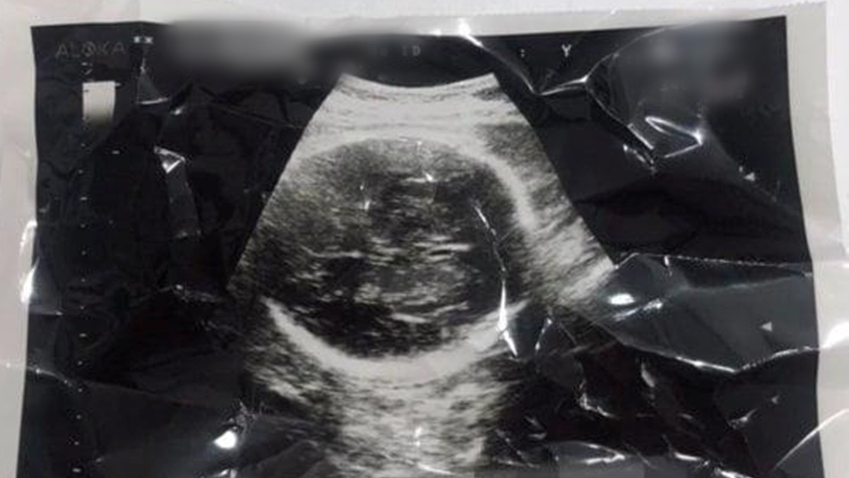 임신 36주 차에 임신중지(낙태) 수술을 받은 산모 권씨가 유튜브에 올린 태아 초음파 사진 / 유튜브 캡처