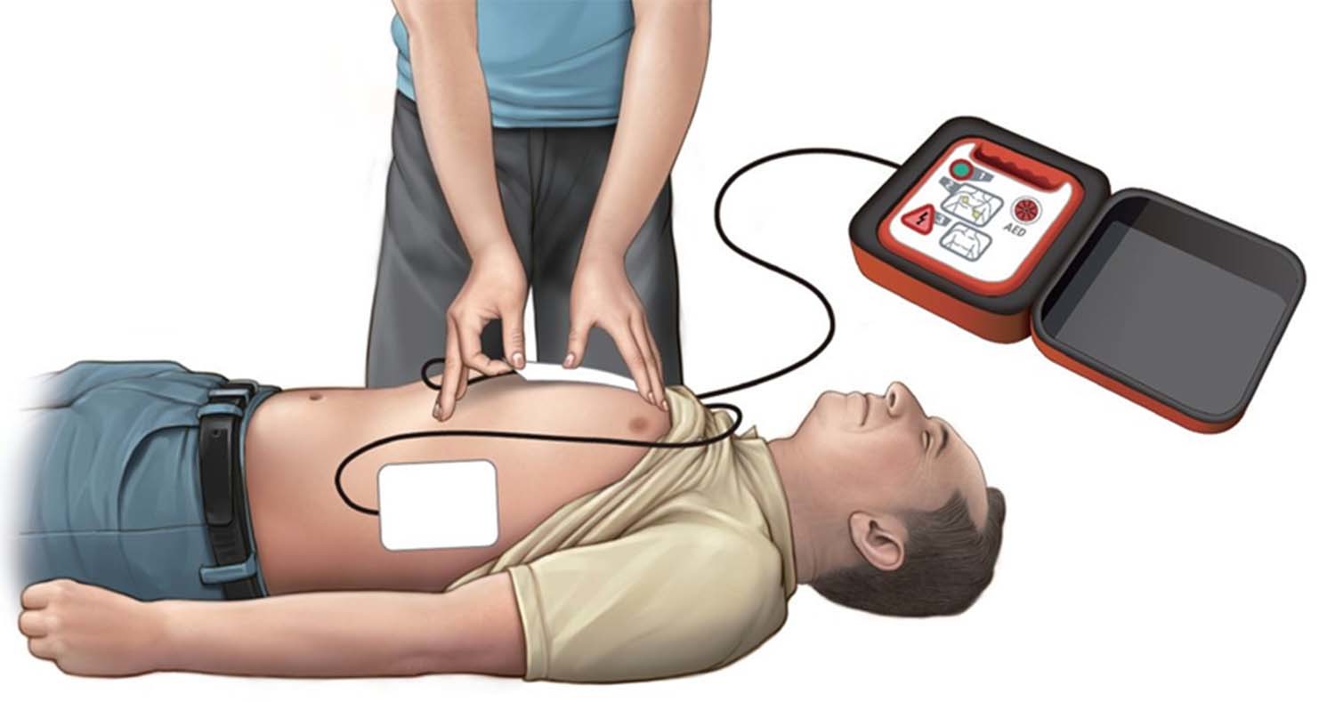 자동심장충격기 패드(전극) 부착 위치 / 질병관리청