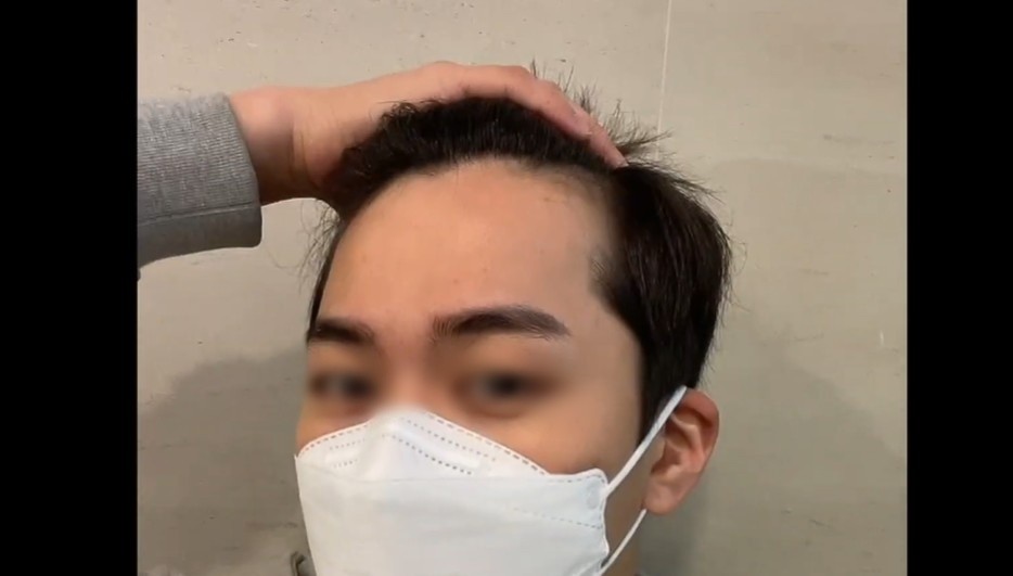 M자형 탈모 수술 경험을 전했던 한 유튜버의 수술 전 이미지 / 유튜브 '승킴 Seung kim - 남자의 관리'