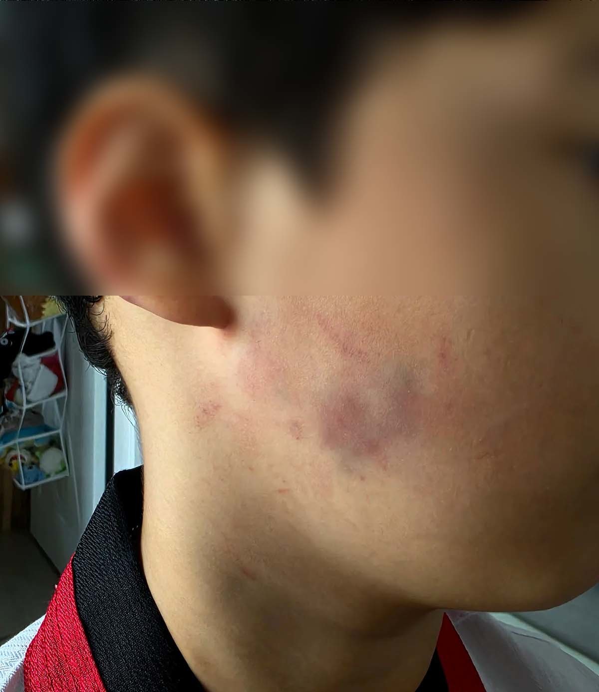 학부모 A씨는 자신의 아들이 잘못하지 않았음에도 피멍이 들 정도의 체벌을 받았다고 주장한다. / 스레드