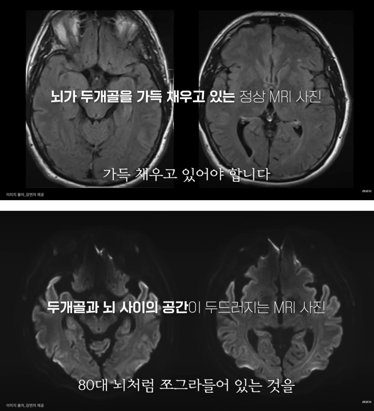 정상적인 뇌(위)와 비정상적으로 쪼그라 든 뇌(아래), 비교 MRI 사진. /  유튜브 '세바시 강연 Sebasi Talk'